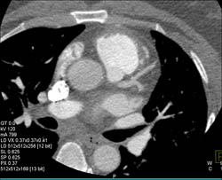 Myocardial Bridging - CTisus CT Scan