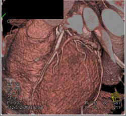 Myocardial Bridging - CTisus CT Scan