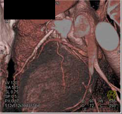 Myocardial Bridging - CTisus CT Scan