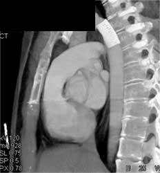 Stent for Repair of Coarctation - CTisus CT Scan