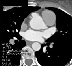 Coronary Artery Aneurysm - CTisus CT Scan