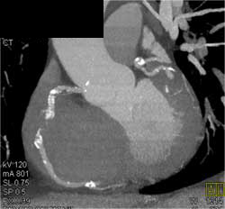 Diseased RCA - CTisus CT Scan