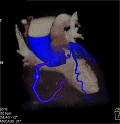 Diseased RCA - CTisus CT Scan