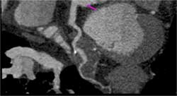 Diseased LAD - CTisus CT Scan