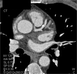 Plaque in LAD - CTisus CT Scan