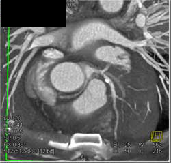 Plaque in LAD - CTisus CT Scan