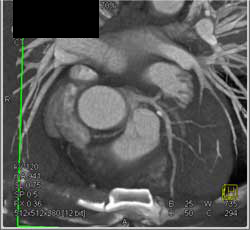 Plaque in LAD - CTisus CT Scan