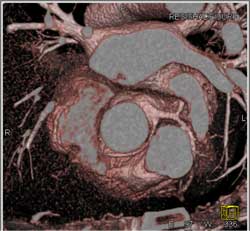 RCA Arises Off the Left Cusp - CTisus CT Scan