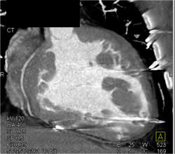 Prominent Myocardial Bundles - CTisus CT Scan