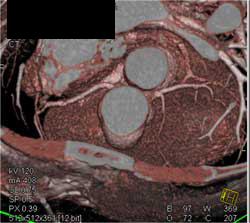 RCA & Left Coronary Artery Single Cusp - CTisus CT Scan