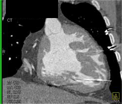 Prominent Single Ventricle - CTisus CT Scan