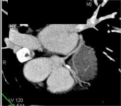 Plaque LAD - CTisus CT Scan