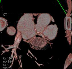 Plaque LAD - CTisus CT Scan