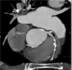 Calcified and Noncalcified Plaque LAD - CTisus CT Scan