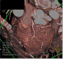 Normal LAD & Circumflex - CTisus CT Scan