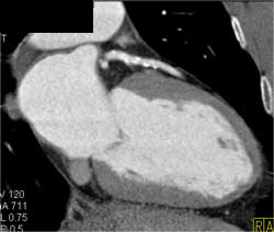 Plaque With Minimal Stenosis LAD - CTisus CT Scan