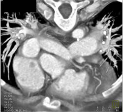 Repaired Tof - CTisus CT Scan