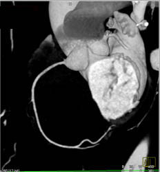 Varying Reconstructions of A Normal RCA - CTisus CT Scan