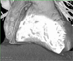 Step Off Due to Computer Generated Artifact - CTisus CT Scan