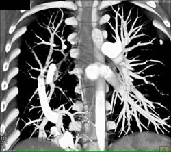 Scimitar Sign With Prior Embolization - CTisus CT Scan