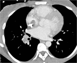 Clot Near SVC Cathetar - CTisus CT Scan