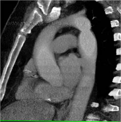 Coarctation of the Aorta - CTisus CT Scan