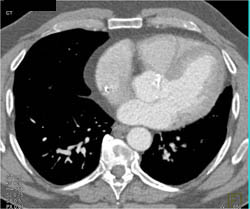 Coarctation of the Aorta - CTisus CT Scan