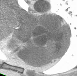 Bicuspid Valve in Patient With Coa - CTisus CT Scan