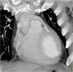 Patent Bypass Grafts - CTisus CT Scan