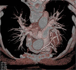 Patent Bypass Grafts - CTisus CT Scan