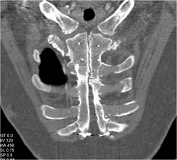 Non-union Lower Sternum - CTisus CT Scan