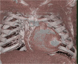 Aortic Valve Calcifications - CTisus CT Scan