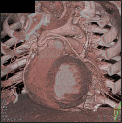 Bypass Grafts - CTisus CT Scan