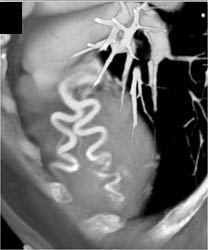 Dilated Left Coronary Artery - CTisus CT Scan