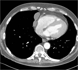 Paracardiac Nodes - CTisus CT Scan