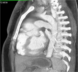 Type A Dissection - CTisus CT Scan