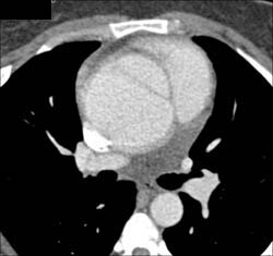 Type A Dissection - CTisus CT Scan