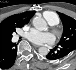 Dilated Origin of RCA S/P Reimplantation - CTisus CT Scan