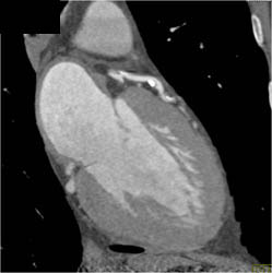 LAD Disease Without Significant Stenosis in Multiple Views - CTisus CT Scan