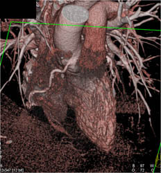 RCA Disease With Multiple Renderings - CTisus CT Scan