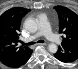 Motion Artifact Simulates A Dissection - CTisus CT Scan