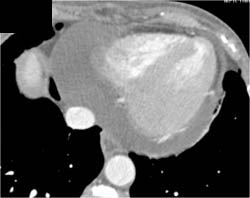 Pericardial Effusion - CTisus CT Scan