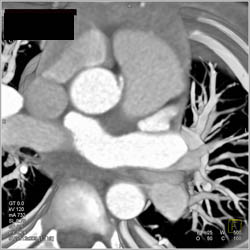 RCA Arises Off Left Cusp - CTisus CT Scan