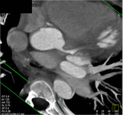 RCA Arises Off Left Cusp - CTisus CT Scan