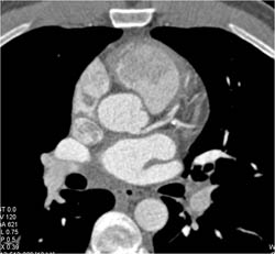 Non Calcified Plaque in LAD - CTisus CT Scan