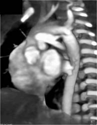 Coarctation of the Aortia With Patent PDA (Patent Ductus Arteriosus) - CTisus CT Scan