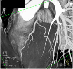 Pseudolesion in First Diagonal Branch - CTisus CT Scan