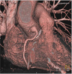 Dilated Origin of RCA S/P Repair of Aortic Root - CTisus CT Scan