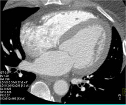 Small RCA in Left Dominant Circulation - CTisus CT Scan