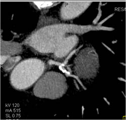 Diseased LAD With Greater Than 50% Stenosis - CTisus CT Scan